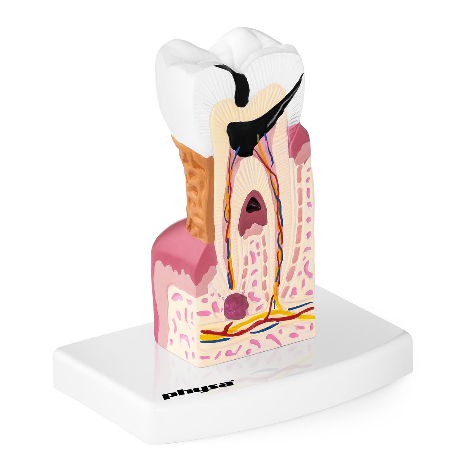 Chory ząb - model anatomiczny